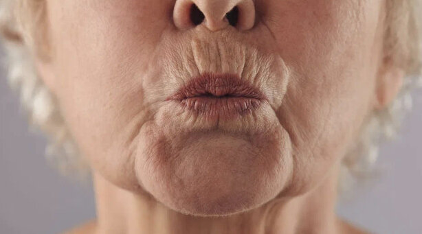 Кисетные морщины (фото из интернета)