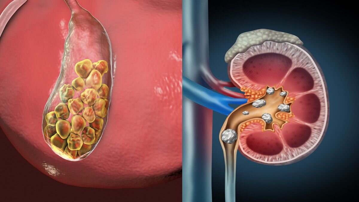 Какая связь между камнями в почках и в желчном пузыре? | Диетолог Николай  Тихенко | Дзен