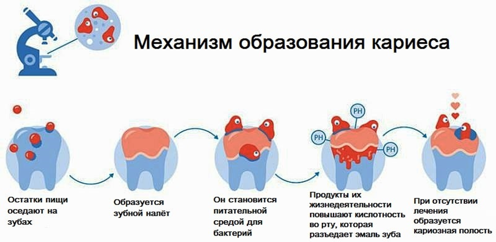 Почему образуется. Причины развития кариеса зубов. Механизм образования кариеса зубов. Кариес причины возникновения. Кариес зубов механизм развития