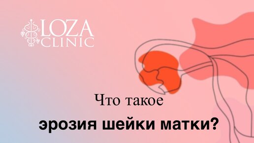ЛОЗА клиник | Что такое эрозия шейки матки? Подробнее в комментариях ...