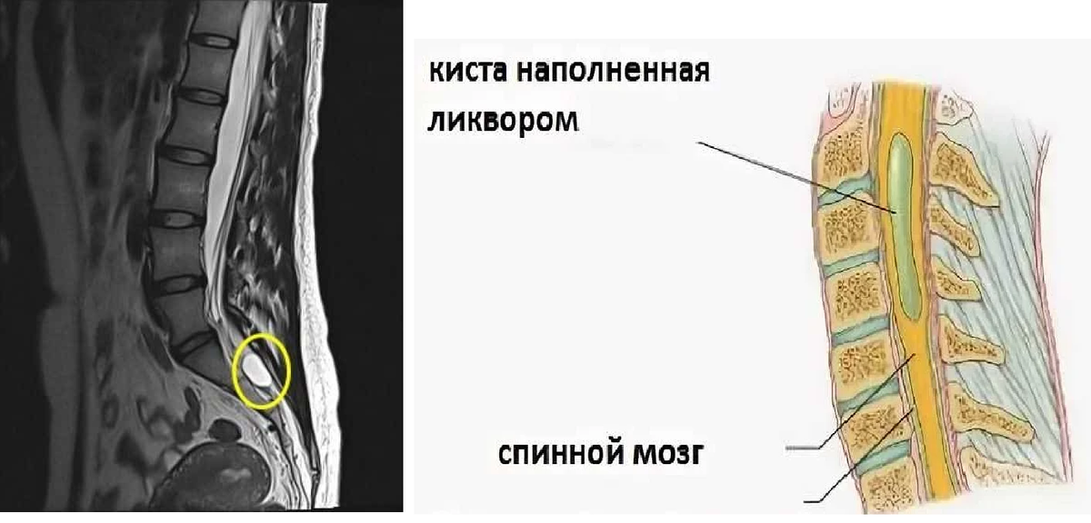 Операция кисты позвоночника