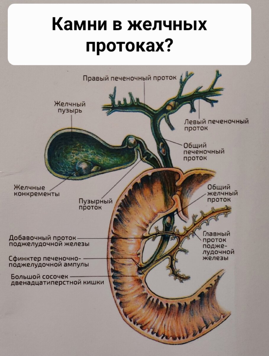 Камни в желчных протоках