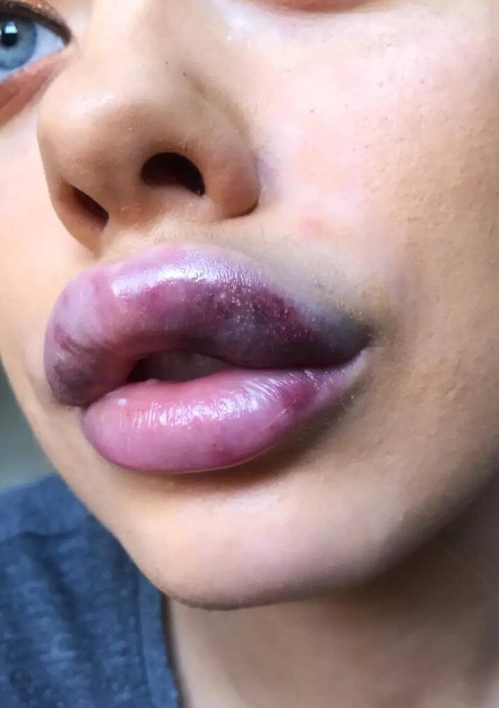 В чем отличия препаратов для увеличения губ?