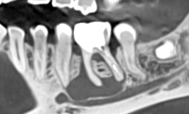 Киста от первого нижнего моляра, которая подбиралась ко второму премоляру. Ни о какой одномоментной имплантации речь не шла, была поставлена цель удаления зуба и кисты.