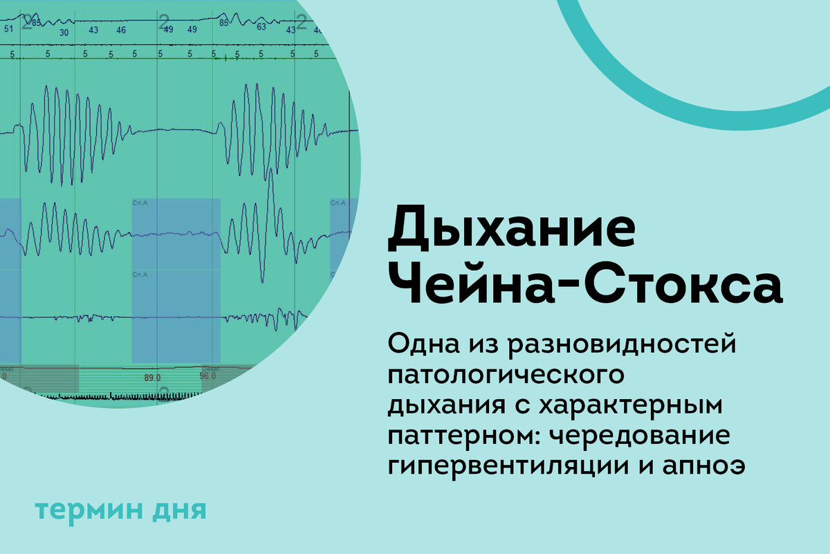 Термин дня: Дыхание Чейна-Стокса