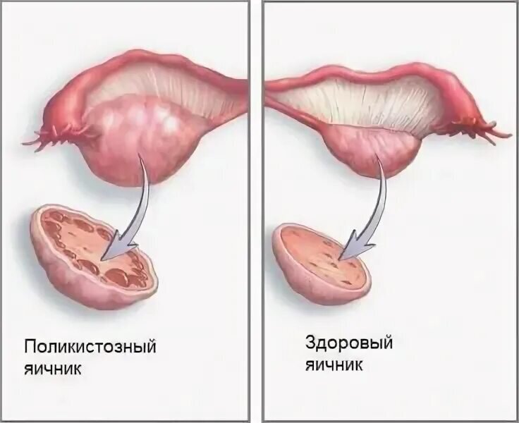 Поликистоз яичников лечение. Поликистоз маточных труб. Формы поликистозных яичников. Каутеризация яичников. Поликистоз яичников операция.