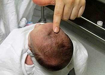 Родничок у новорожденных детей: Анатомия, Функции и Клиническое ...