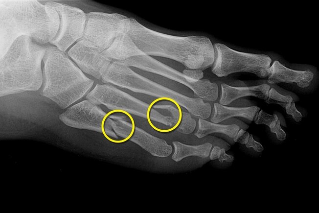 Sănătatea picioarelor este foarte importantă pentru menținerea mobilității la orice vârstă, așa că acest material va fi de interes pentru oricine îi pasă de picioarele lor.-16