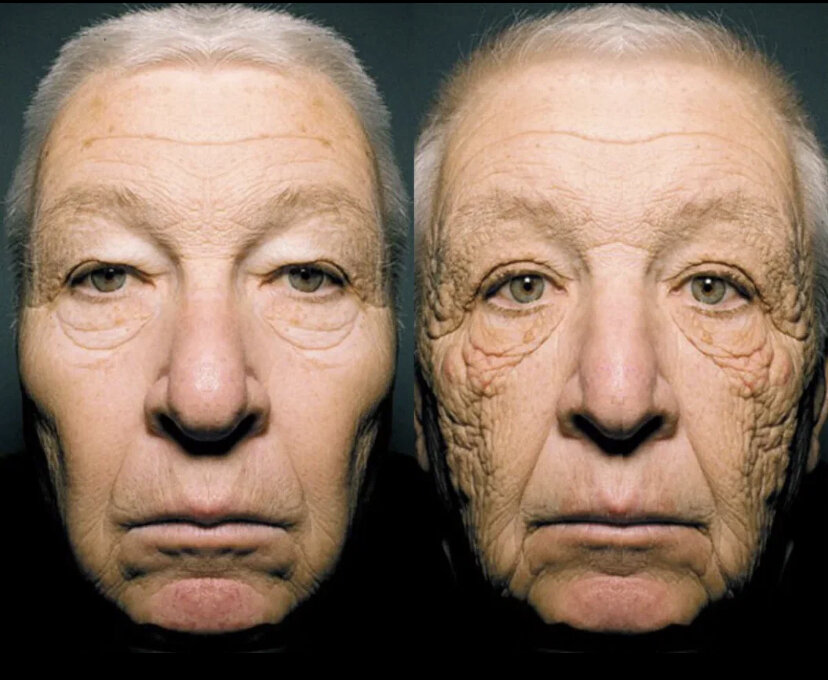 69-летний Билл Макэллигот в течение 28 лет развозил молоко в Чикаго, каждый день подставляя солнцу левую сторону лица, пока сидел за рулем во время своих многочисленных поездок.
В результате он пал жертвой такого явления, как ФОТОСТАРЕНИЕ