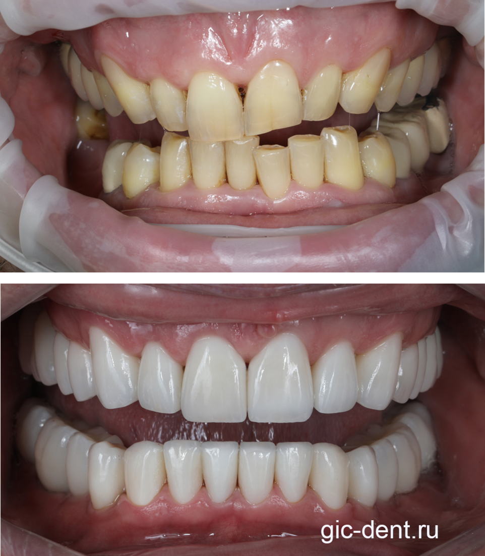 Реставрация челюсти цельнокерамическими винирами в Немецком Имплантологическом Центре. Работа стоматолога-ортопеда Карнеева А.Н. 