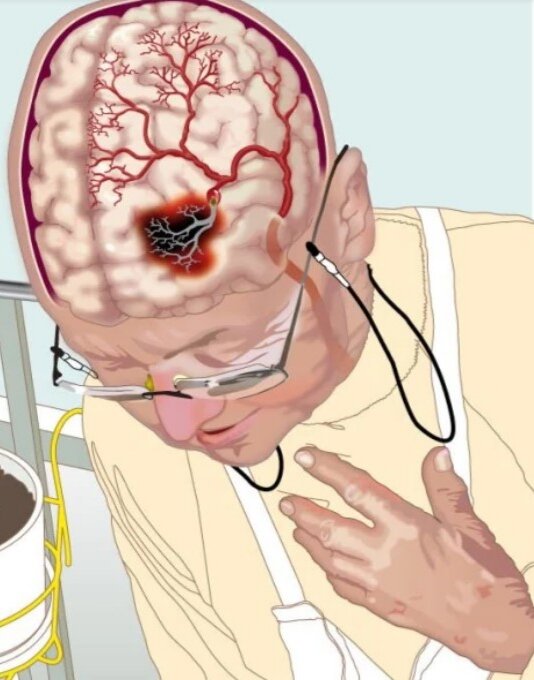 Инсульт продолговатого мозга. Мрт Flair инсульт продолговатого мозга. Сколько человек может выдержать инсультов. Инсульт сколько времени чтоб спасти.