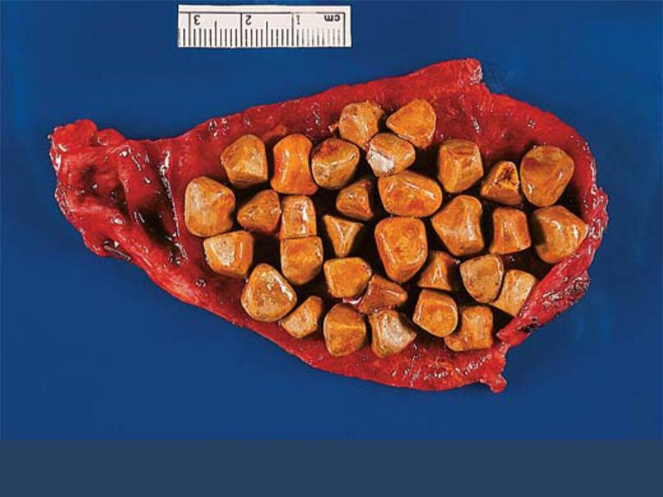 Холестериновые камни 