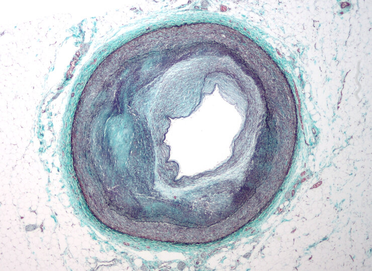 Правая коронарная артерия, ссуженная в результате склеротического поражения. © CC BY-SA 3.0/Nephron