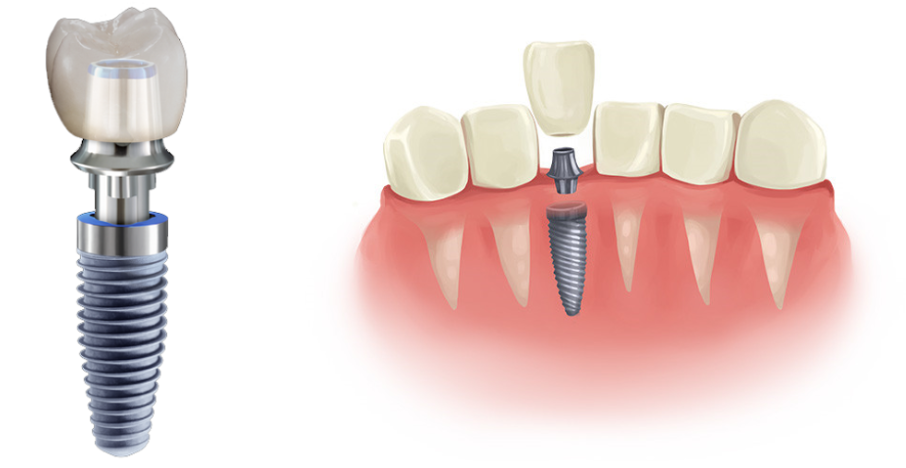 Импланты недорого спб. Имплант Дент.