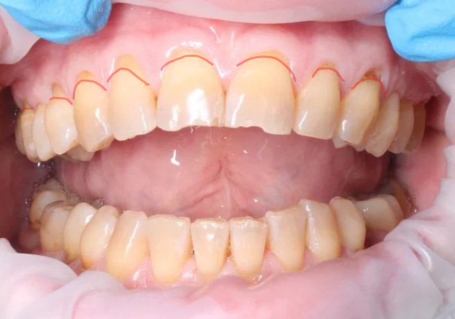 Оголённые корни зубов на верхней челюсти. 