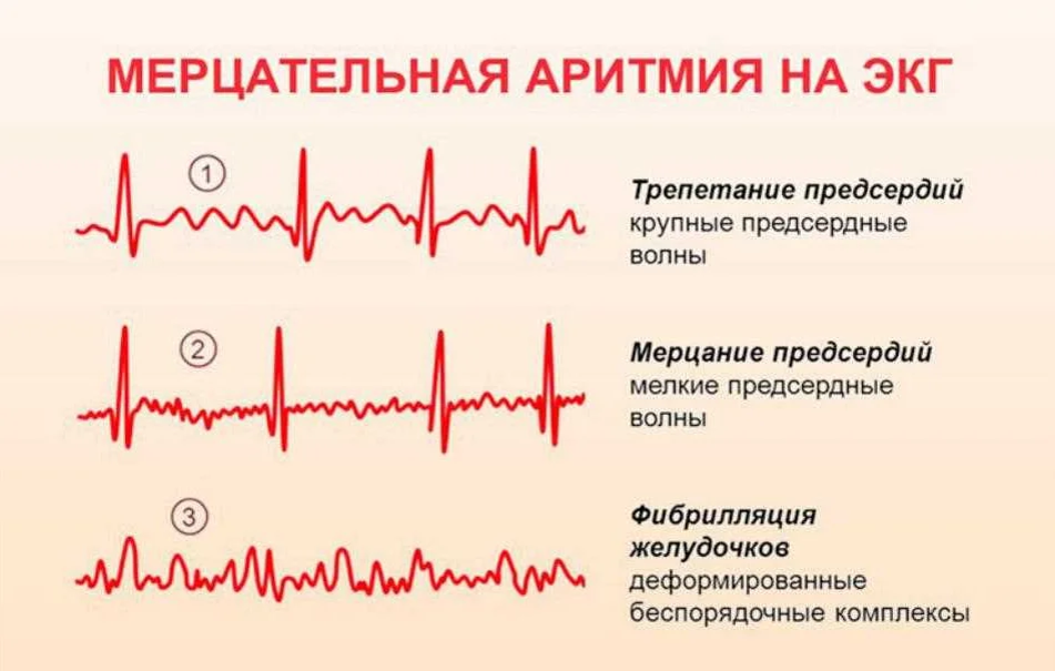 Сбился пульс. Мерцательная аритмия на ЭКГ. Признаки мерцательной аритмии на ЭКГ. Мерцательная аритмия на ЭКГ ЭКГ. Мерцательная аритмия пленка ЭКГ.