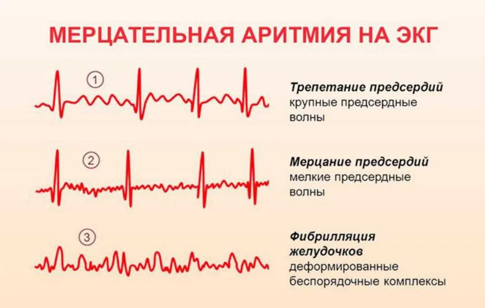 Аритмия сердца симптомы причины и лечение. Мерцательная аритмия на ЭКГ. ЭКГ аритмии фибрилляция. Изменения на ЭКГ при мерцательной аритмии. ЭКГ при мерцат аритмии.