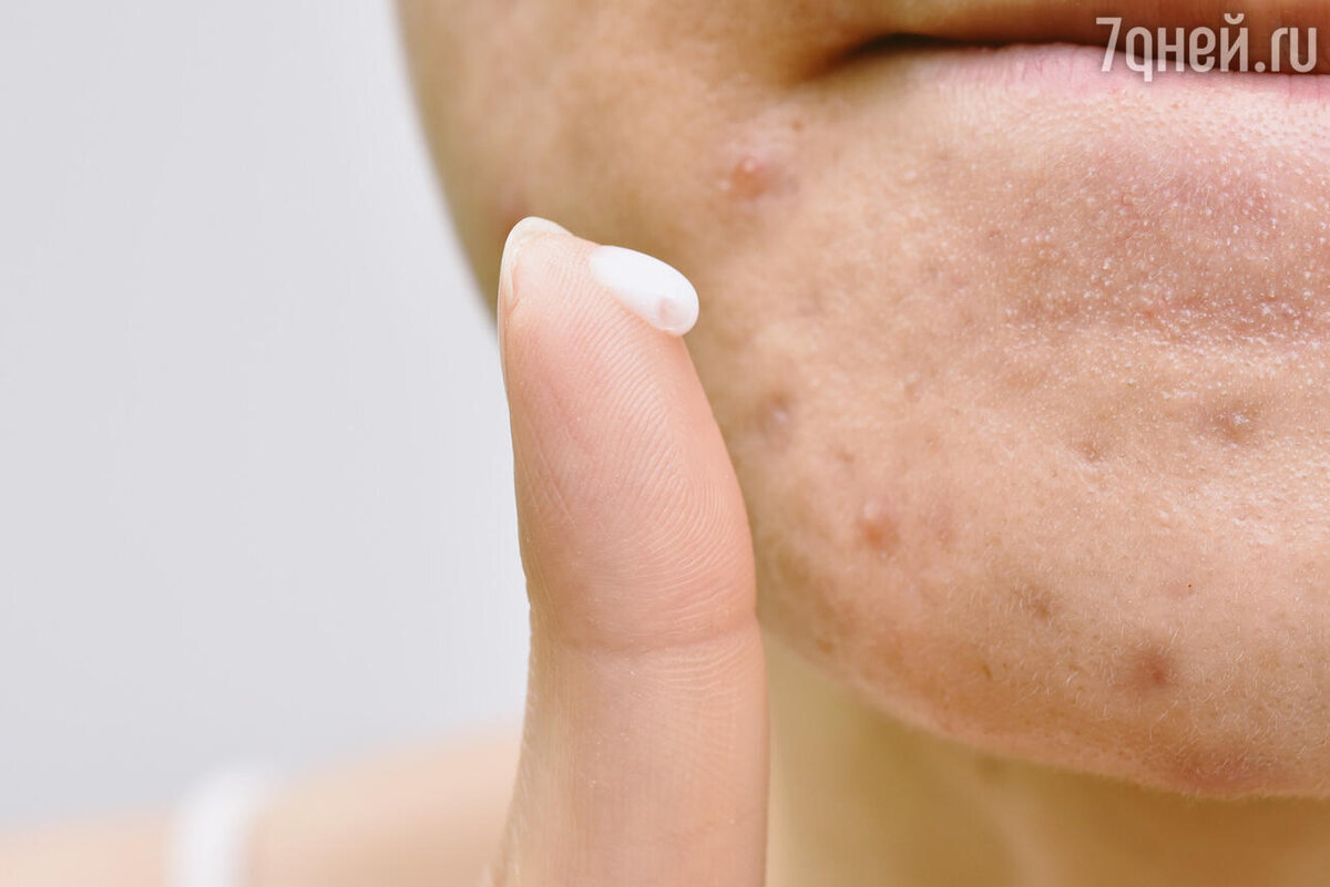    К чему снится гной 123RF/legion-media.ru