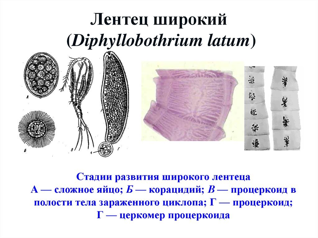 Широкий лентец вызывает тяжелую В дефицитную анемию (Diphyllobothriasis) - Диагностер