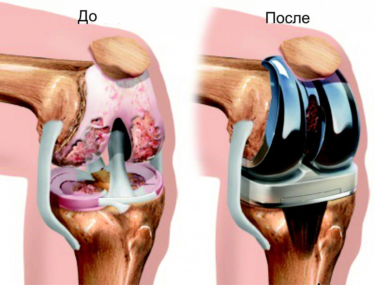 Артроз коленного сустава эндопротез. Гонартроз эндопротезирование коленного сустава. Остеоартроз коленного сустава эндопротез. Гонартроз коленного сустава 2.