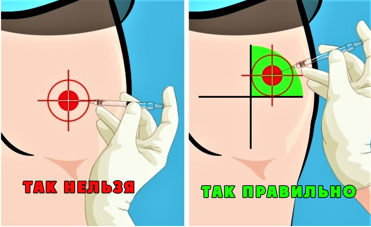 Что делать в домашних условиях если нужно сделать укол в ягодицу | RMI |  Дзен