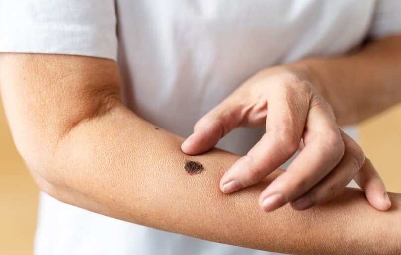 С родинками связано много мифов и антинаучных мнений