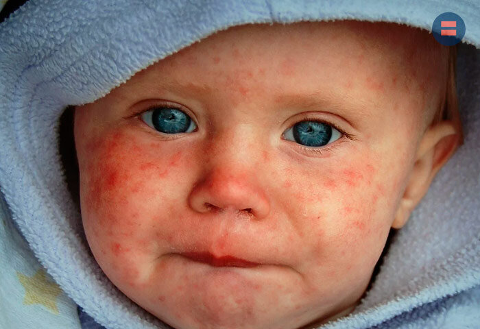 В Пензенской области зафиксировано 78 случаев кори