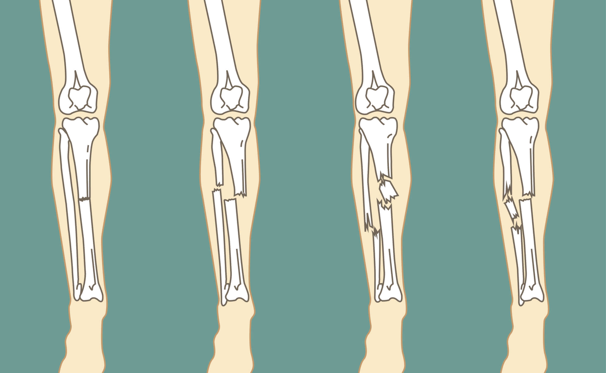Виды переломов костей