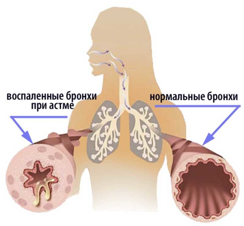 Индуцированная астма. Астма. Бронхиальная астма картинки. Бронхи больного бронхиальной астмой. Бронхиальная астма легкие.