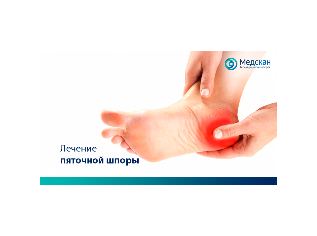 Тейпирование пяточной шпоры. Плантарный фасциит мкб 10. Плантарный фасциит ортопедические стельки. Плантарный фасциит на УЗИ протокол. Плантарный фасциит тейпирование.