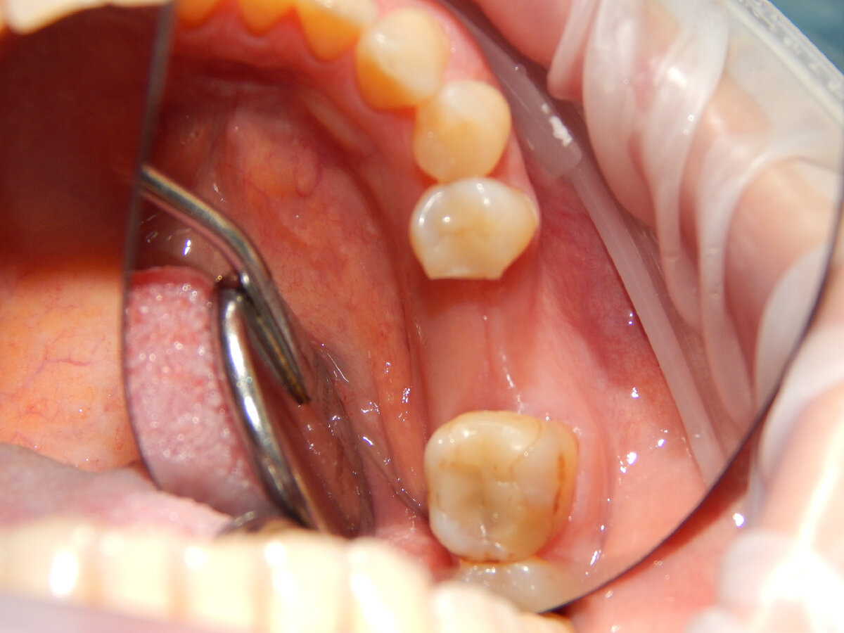 6 зуб слева снизу удален более 4 месяцев назад 