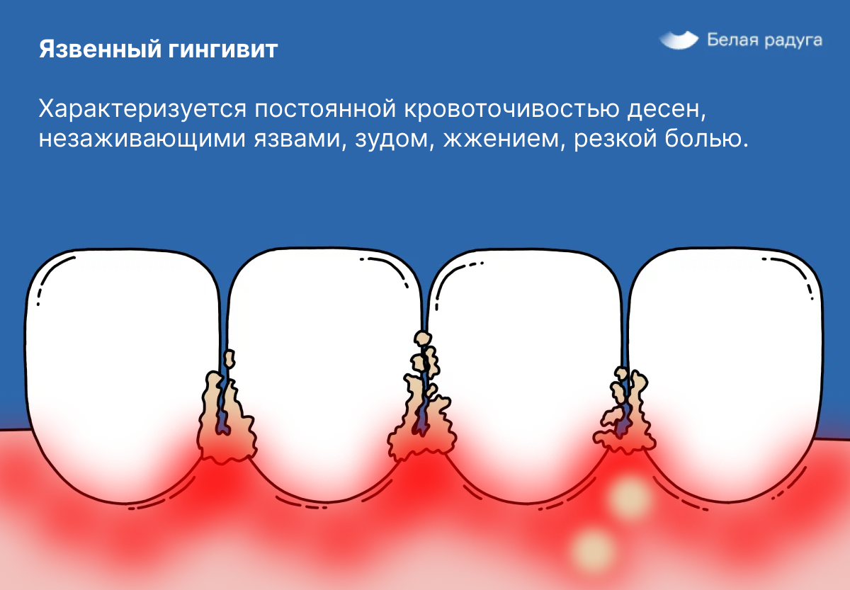 Почему кровоточат десны при чистке зубов | Чем лечить кровоточивость десен