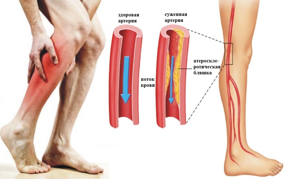 Сводит ногу судорогой в икре причины и диагностика спазмов