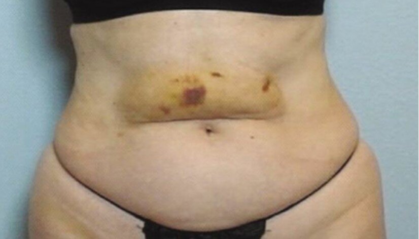 Инъекции липолитика