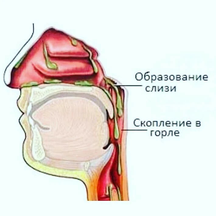 Слизь в горле: почему появляется, как избавиться и чем лечить