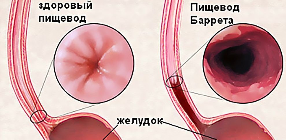 пищевод спроси врача