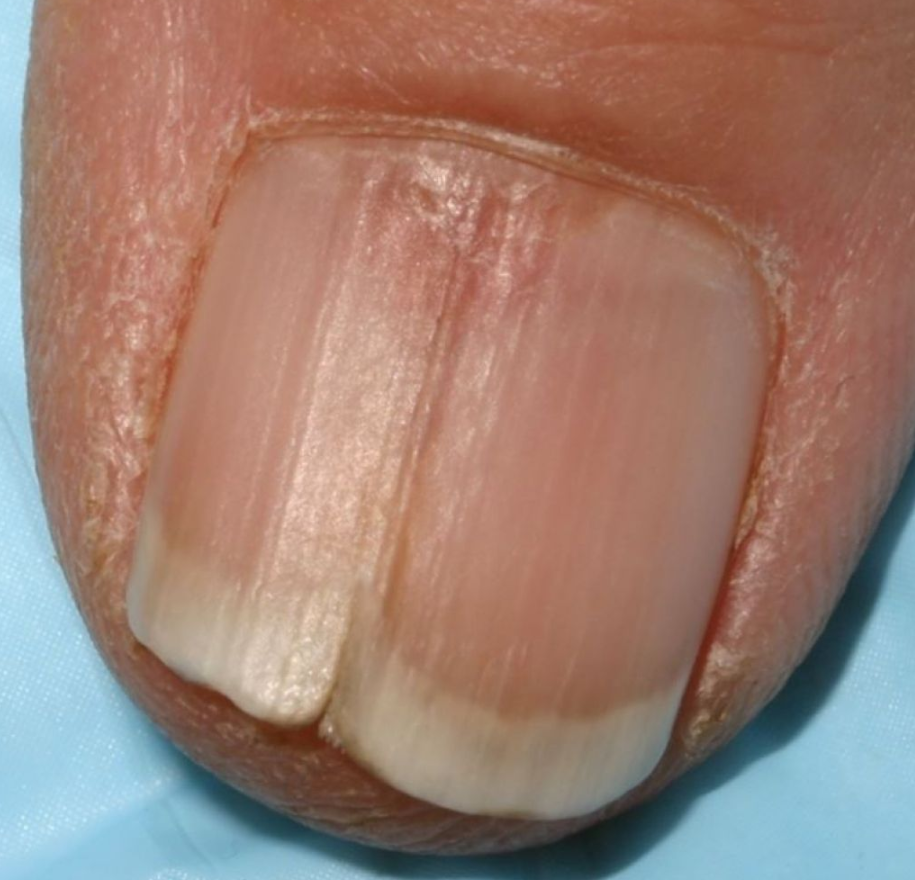 Онихорексис.