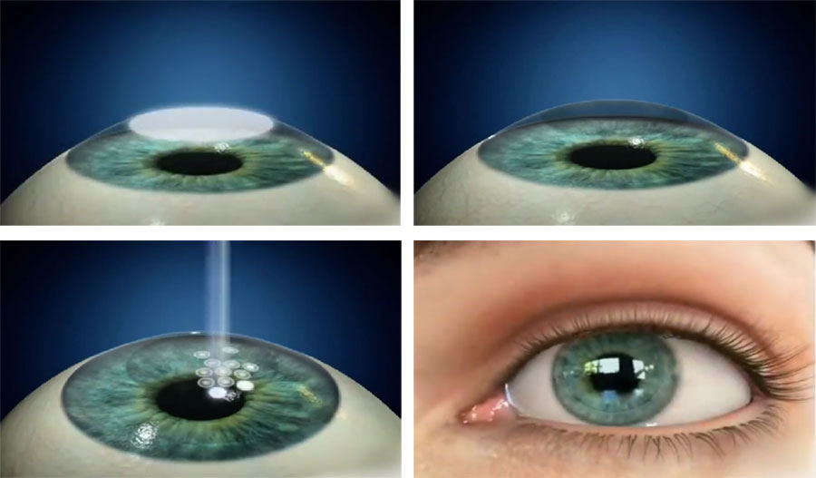 Коррекция зрения сравнение. Метод ФРК лазерная коррекция. Кератоконус кросслинкинг. Коррекция зрения по технологии ФРК (фоторефракционная кератэктомия). Лазерная коррекция зрения методом ласик.