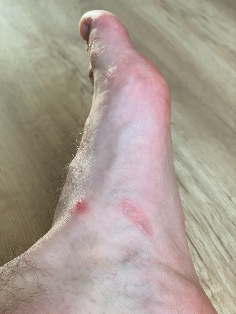 Мозоли. Фото 2