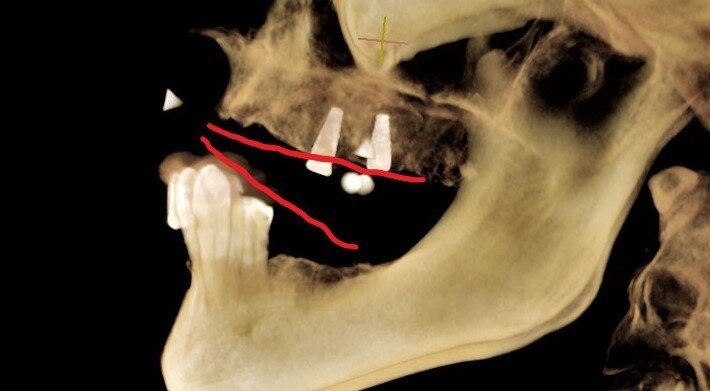 Если "дорисовать" зубной ряд, то получим интересное смыкание..