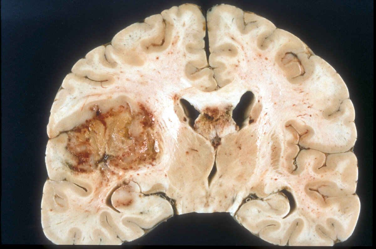 Чем прогноз глиобластомы отличается от других опухолей мозга?