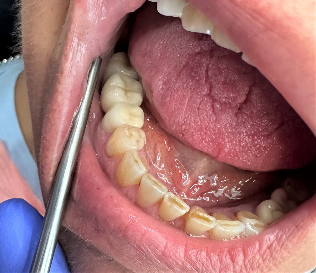 Попытка номер 1 - не нравится ширина зуба человеку, слишком широкий. Субъективные ощущения - но раз не нравится, то переделываем. Жаль, не сфотографировала прилегание. Не думала, что история затянется.