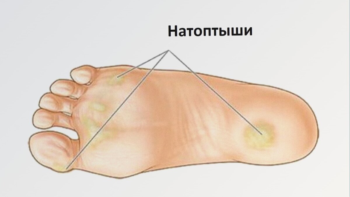 Натоптыши — это грубые и твердые участки кожи, которые образуются на стопах, часто вызывая дискомфорт и болезненные ощущения. Они могут появляться из-за натирания обувью или постоянного давления