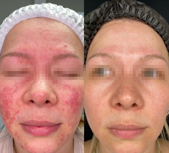 БЫЛО ПРОВЕДЕНО: Фототерапия, Биоревитализация, Мезотерапия и Пилинги.
