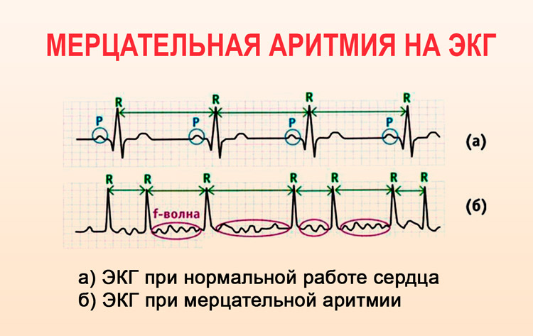 экг при мерцат аритмии. мерцательная аритмия на экг экг. мерцательная аритмия на экг. мерцательная аритмия на экг с расшифровкой. экг-признаком мерцательной аритмии является:.