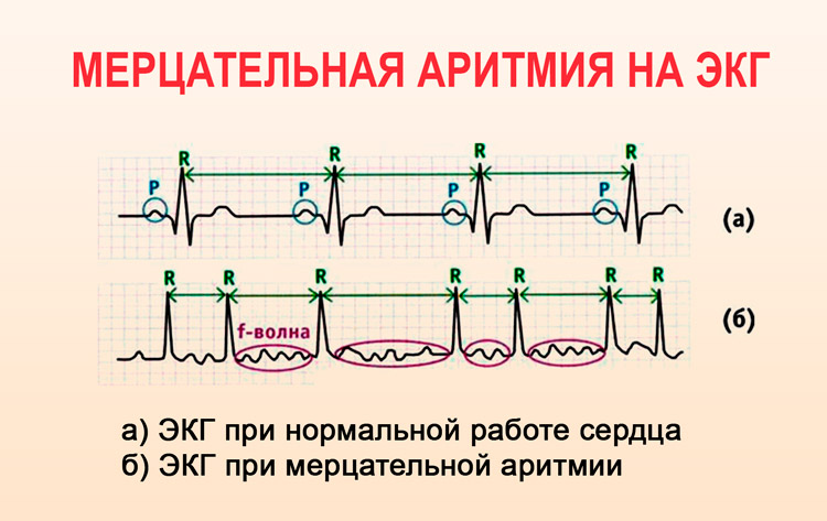 Экг при мерцательной аритмии в картинках