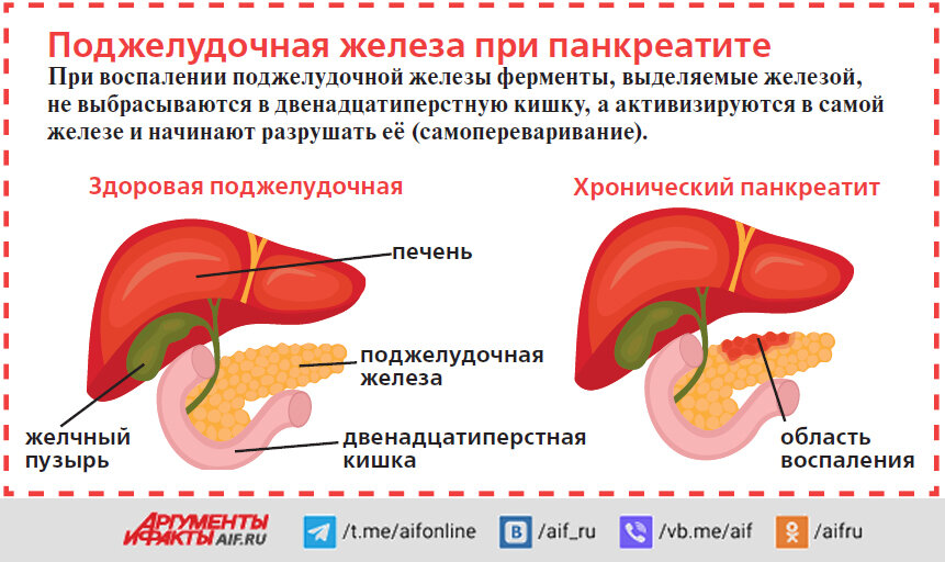 Снятие воспаления поджелудочной. Панкреатит поджелудочной железы. Лекарство от панкреатита поджелудочной железы. Капельницы для поджелудочной железы при панкреатите. Таблетки от панкреатита поджелудочной железы.