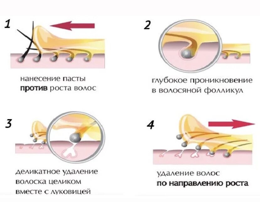 Мануальный метод удаления волос