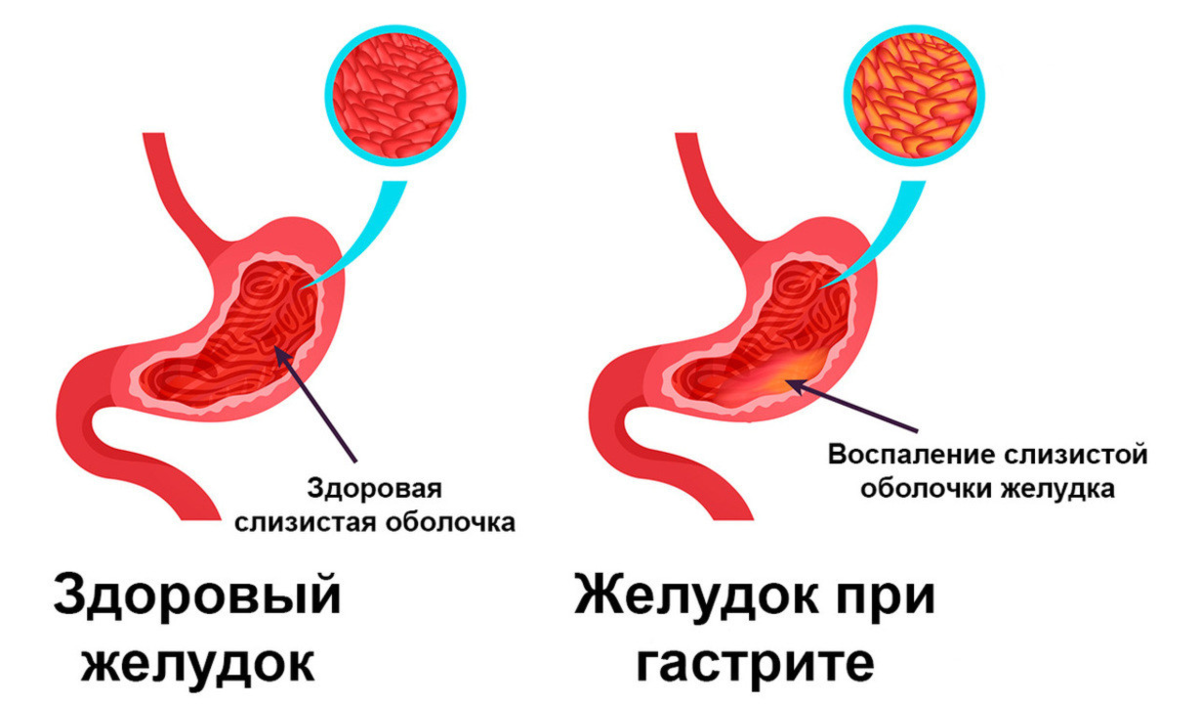 Симптомы гастрита желудка. Желудок с повышенной кислотностью. Острый гастрит с повышенной кислотностью. Кислотность желудка картинка.