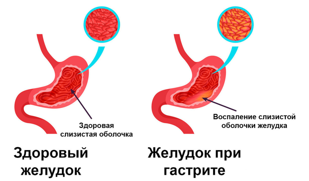 Гастрит желудка симптомы у женщин после 60